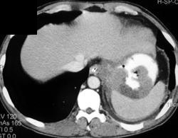 Gastric Cancer With Ulceration - CTisus CT Scan