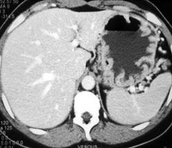 Gastritis - CTisus CT Scan