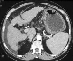 Gastritis and Cirrhosis - CTisus CT Scan