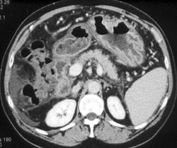 Gastritis Due to Cirrhosis and Portal Hypertension - CTisus CT Scan