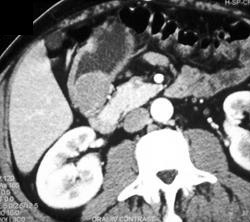 Leiomyoma Antrum - CTisus CT Scan