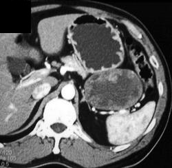 Gist Off Stomach - CTisus CT Scan