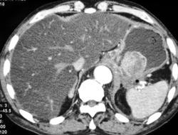 GIST Tumor - CTisus CT Scan