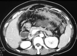 Gastric Cancer Extends Into Transverse Colon. Ascites Also Seen. - CTisus CT Scan