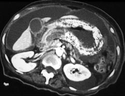 Mucinous Gastric Cancer and Carcinomatosis - CTisus CT Scan