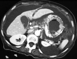 Carcinomatosis Due to Mucinous Gastric Cancer - CTisus CT Scan