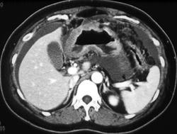 Gastric Adenocarcinoma - CTisus CT Scan