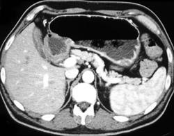 Antral Carcinoma - CTisus CT Scan