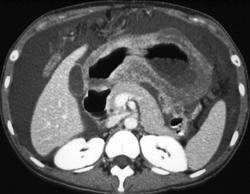 Linitis Plastica - CTisus CT Scan