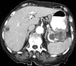 Gastric Cancer With Liver Metastases - CTisus CT Scan