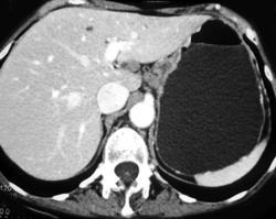 Gastric Cancer and Portocaval Nodes - CTisus CT Scan