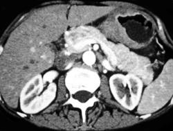 Gastric Lymphoma - CTisus CT Scan