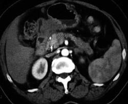 Gastric Cancer - CTisus CT Scan