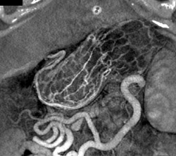 Normal Gastric Mucosa - CTisus CT Scan