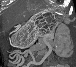 Normal Gastric Folds - CTisus CT Scan