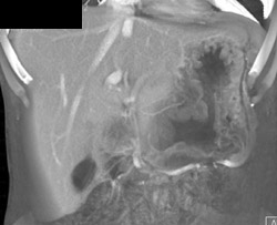 Gastric Lymphoma - CTisus CT Scan