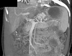 Gastric Varices and Gastritis - CTisus CT Scan