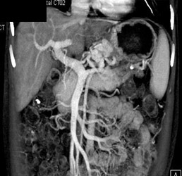 Gastritis and Gastric Varices - CTisus CT Scan