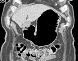 Antral Carcinoma - CTisus CT Scan