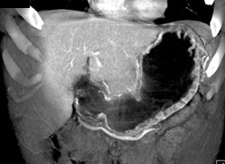 Gastritis - CTisus CT Scan