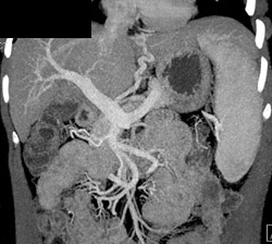 Gastric Varices - CTisus CT Scan