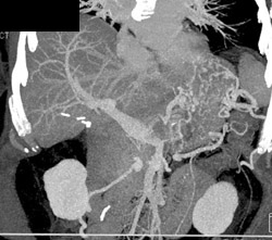 Gastric Varices and Occluded Splenic Vein - CTisus CT Scan