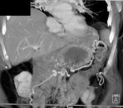 Gastric Varices With Occluded Splenic Vein - CTisus CT Scan