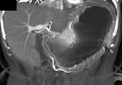 3D of the Stomach - CTisus CT Scan