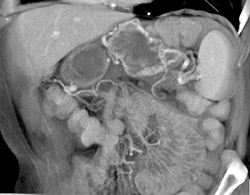 Occluded Splenic Vein and Gastric Varices - CTisus CT Scan