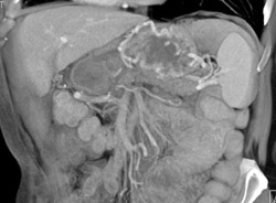 Gastric Varices - CTisus CT Scan