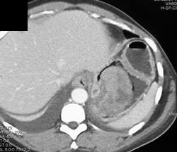 Intragastric GIST Tumor - CTisus CT Scan