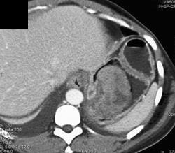 GIST Tumor - CTisus CT Scan