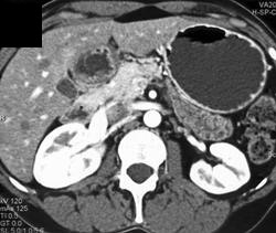 Normal Stomach - CTisus CT Scan