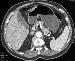 Gastric Cancer - Stomach Case Studies - CTisus CT Scanning