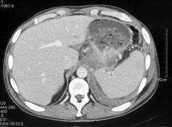 Gastric Cancer Infiltrates Near Gastroesophageal (GE) Junction - CTisus CT Scan