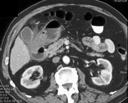 Gastritis With Acute Cholecystitis - CTisus CT Scan