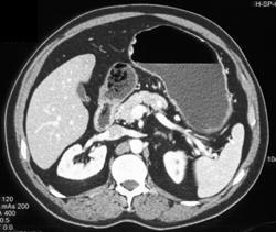 Gastric Polyps - CTisus CT Scan