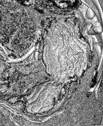 Shaded Display of Gastric Folds - CTisus CT Scan