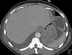 Gastric GIST Tumor - CTisus CT Scan