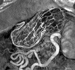 Normal Gastric Folds - CTisus CT Scan