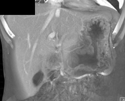 Gastric Lymphoma - CTisus CT Scan