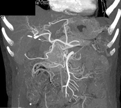 Gastritis - CTisus CT Scan