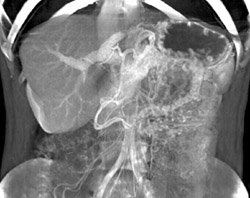 Gastritis - CTisus CT Scan