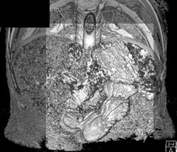 Gastric Folds in 3D - CTisus CT Scan