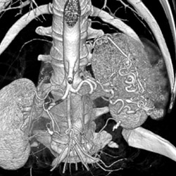 Normal Gastric Vessels - CTisus CT Scan