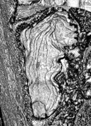 Normal Gastric Folds - CTisus CT Scan