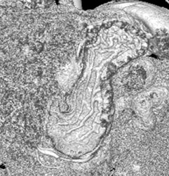 Normal Gastric Folds - CTisus CT Scan