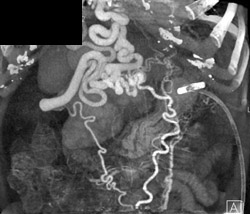 Varices and Gastrostomy Tube - CTisus CT Scan