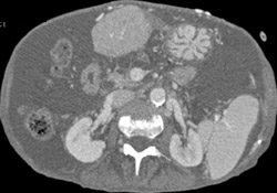 Gastrostomy Tube and Abdominal Wall Varices - CTisus CT Scan