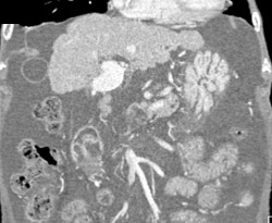 Gastritis - CTisus CT Scan